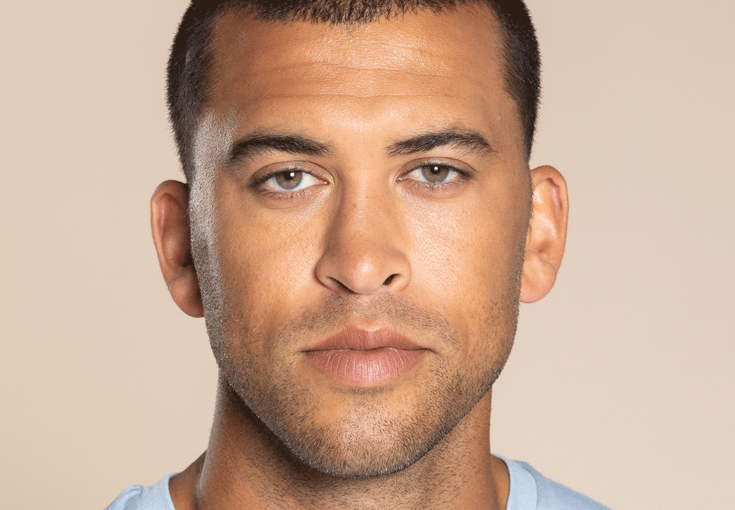 SpaDerma-Dysport-SpaDerma