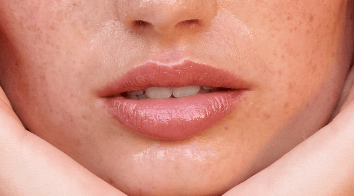 Lips that look plumped due to lip filler
