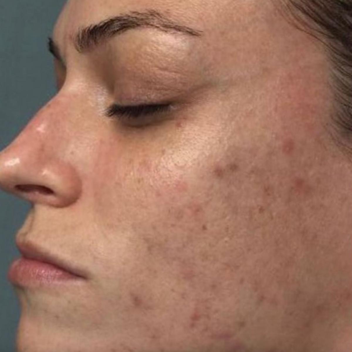 Mild to severe acne can be treated with our targeted treatment series