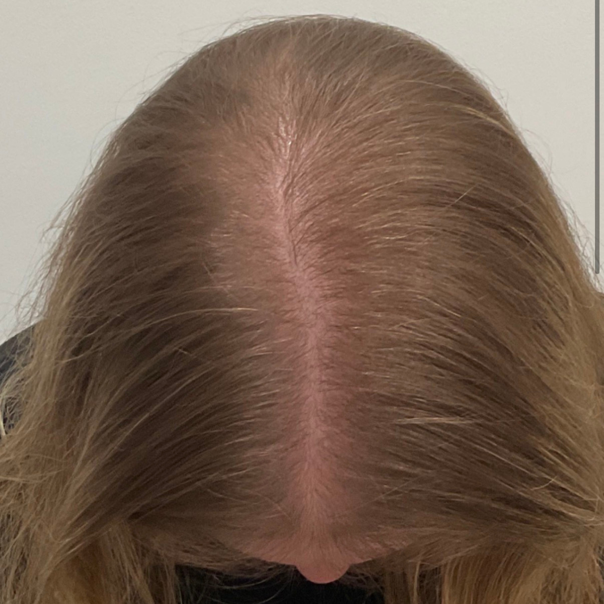 Close-up of a person's head with light brown hair, showing the scalp.