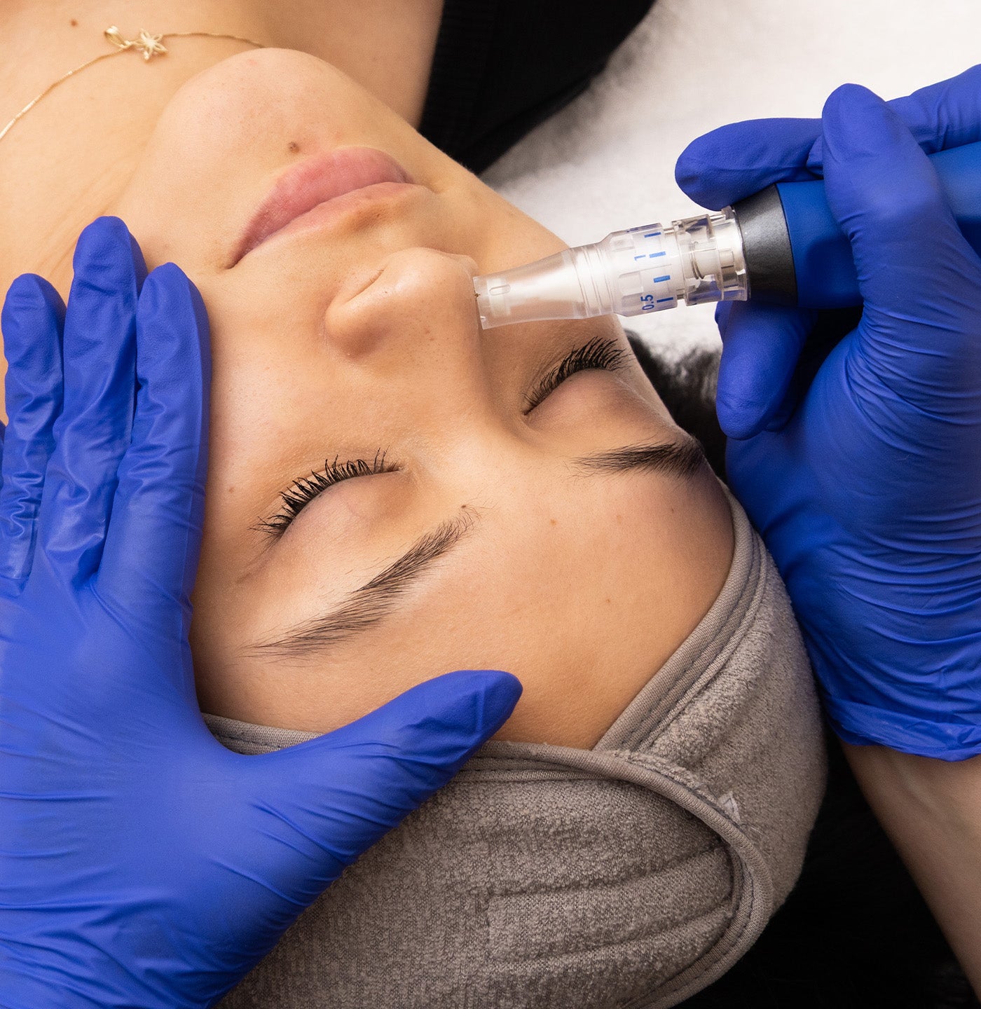 SkinPen Microneedling