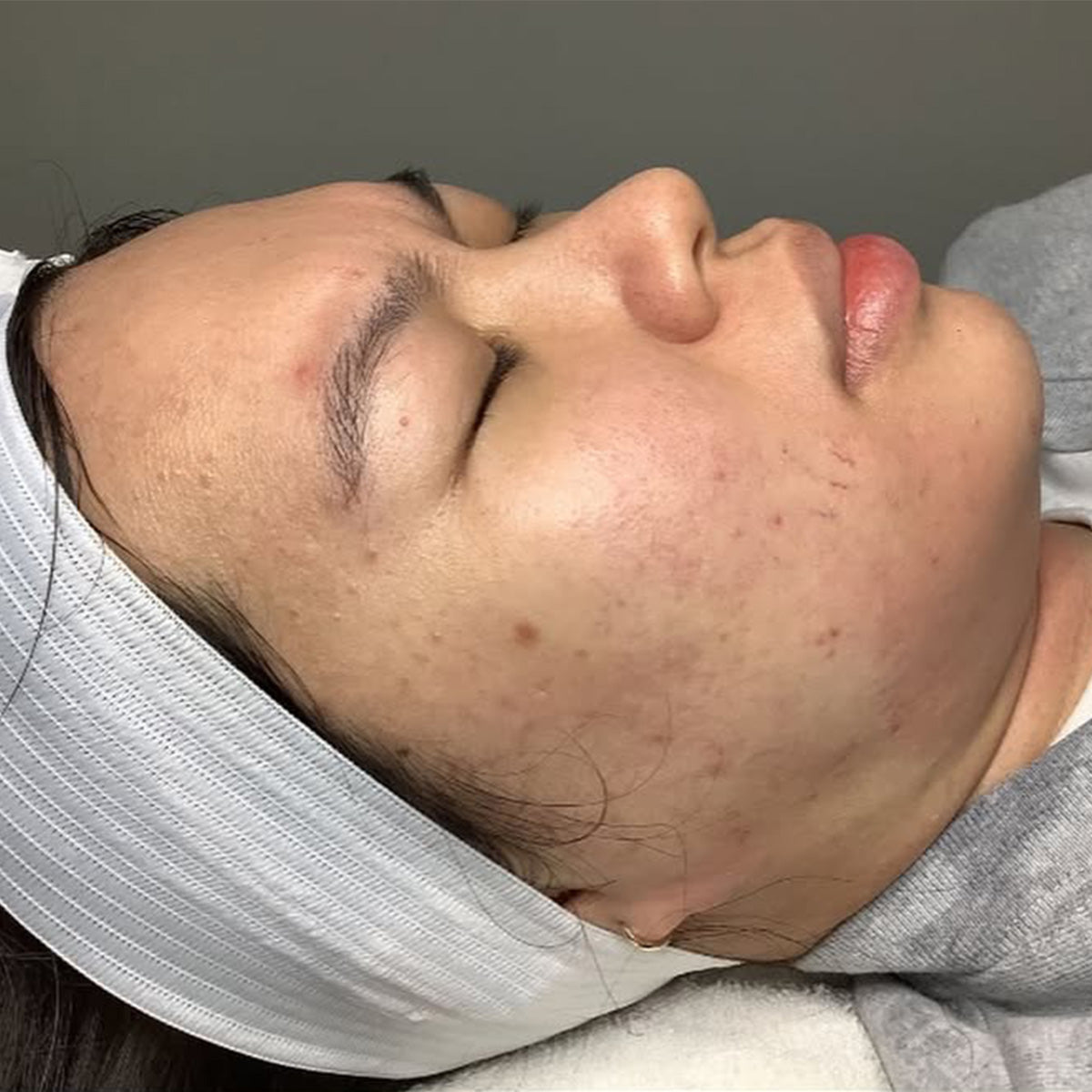 Spaderma_Web_Treatments_BA_1200x1200before_8cbae6ad-a790-4574-918c-cf60ea75ceba.jpg