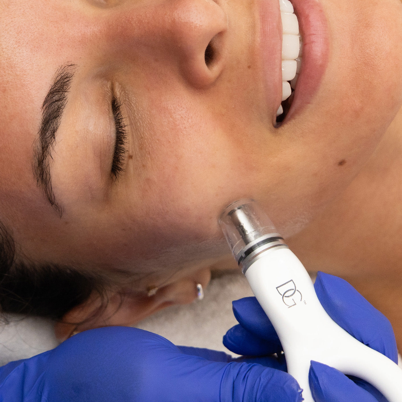 Person receiving a cosmetic procedure with a device held by a gloved hand.