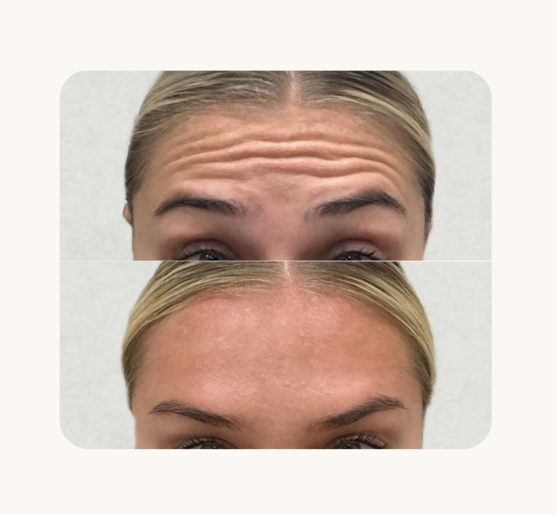 Before and after comparison of a woman's forehead with and without wrinkles.