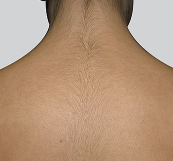 laser-hair-removal-before