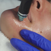 Hydrafacial treatment process at SpaDerma