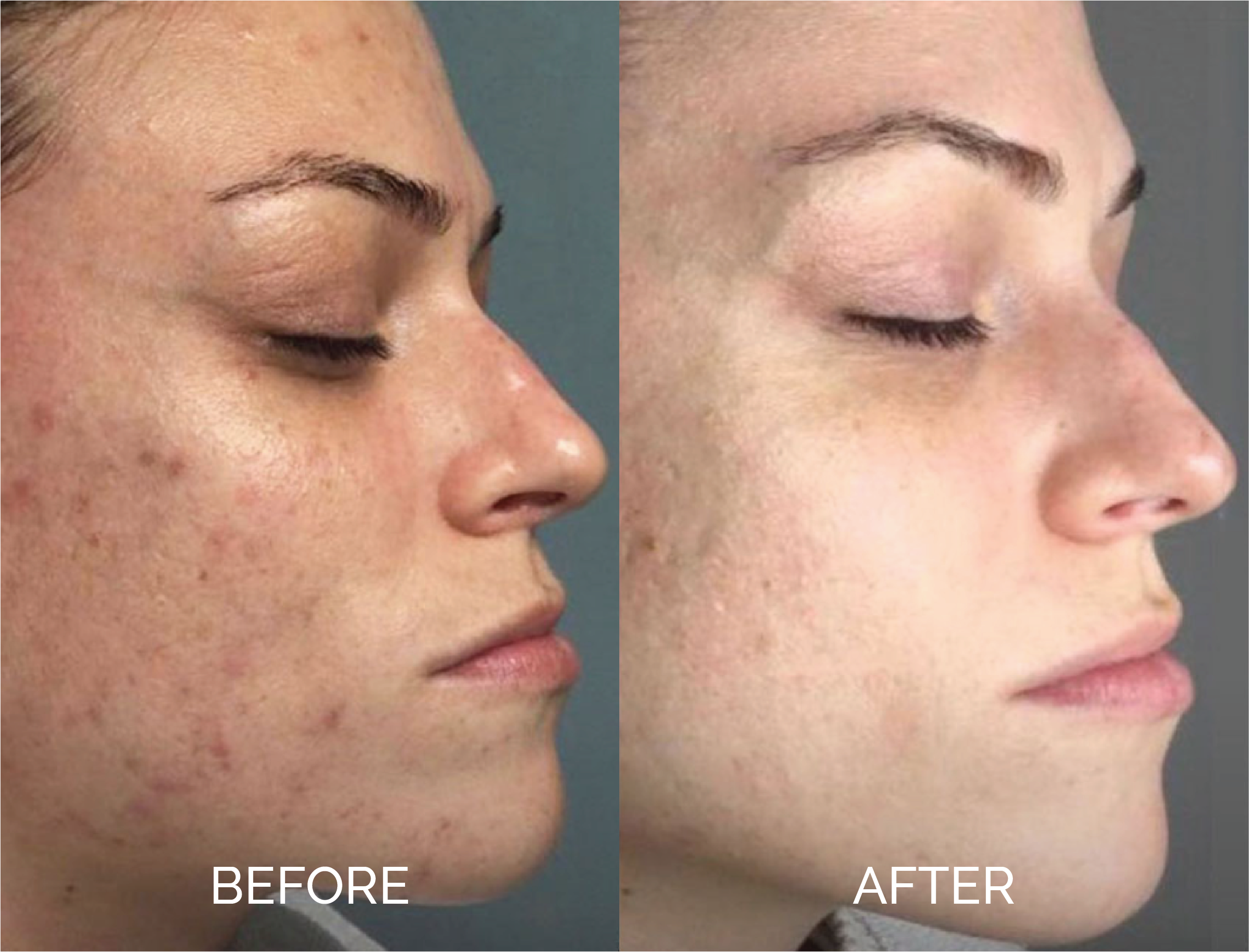 Chemical Peel treatment before and after results